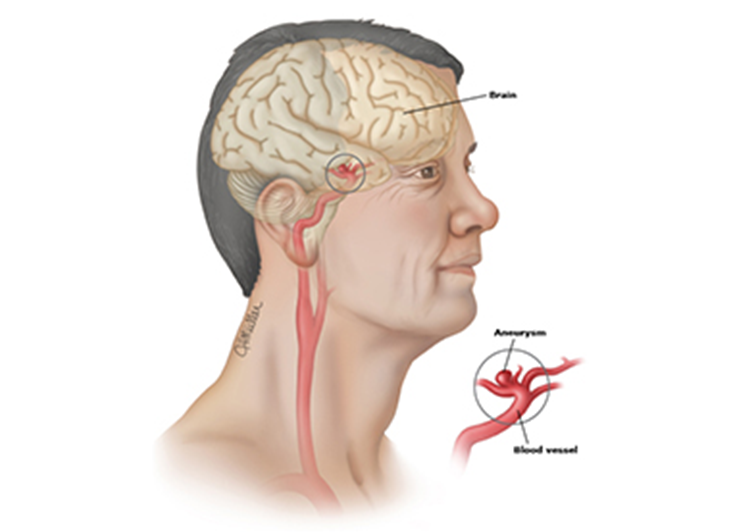 颅内动脉瘤